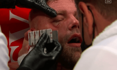 Billy Joe Saunders Has Fractured Orbital, Needs Surgery