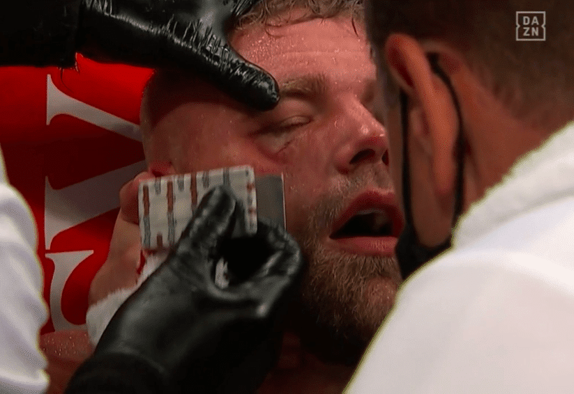 Billy Joe Saunders Has Fractured Orbital, Needs Surgery